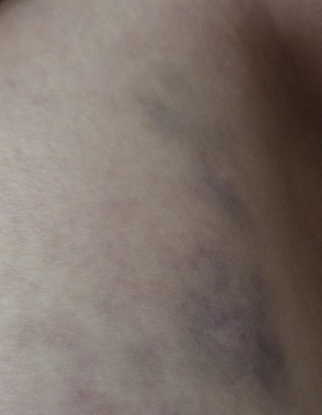 Ma blessure de guerre! La seule visible